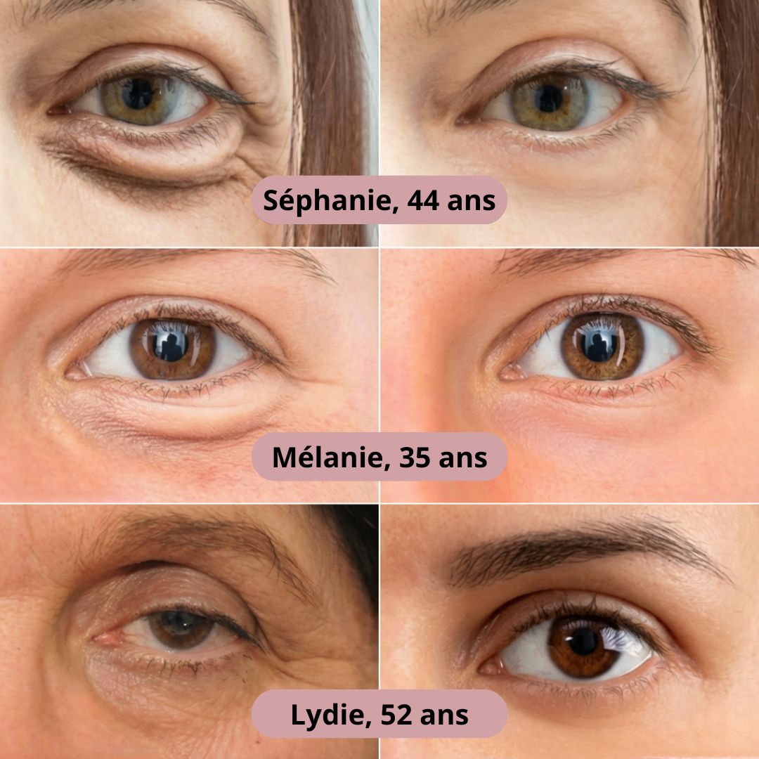 Patchs aux micro-aiguilles KEMORA