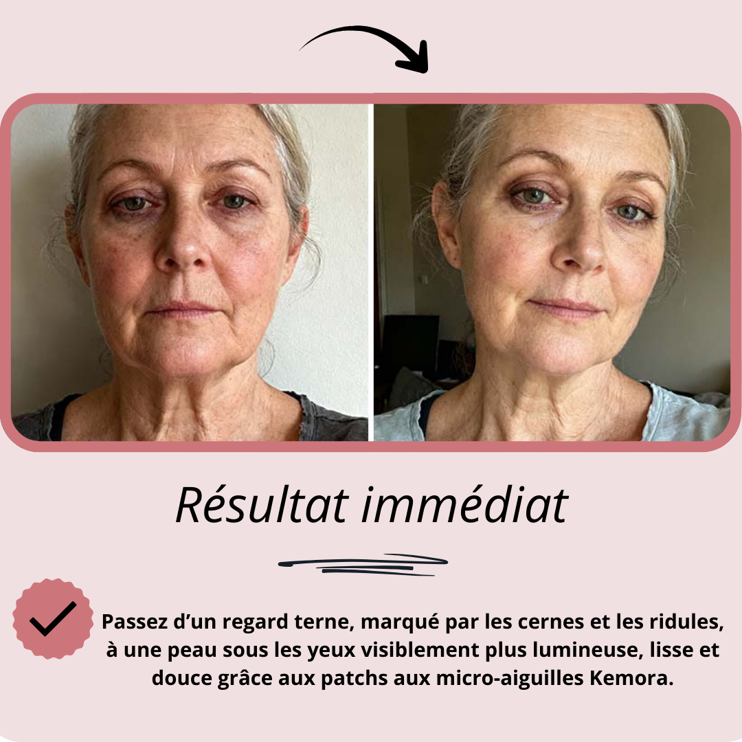 Patchs aux micro-aiguilles KEMORA