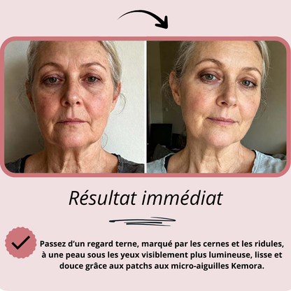 Patchs aux micro-aiguilles KEMORA