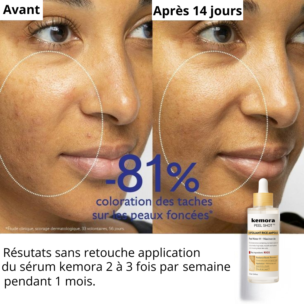 Kemora PEEL SHOT  – Sérum exfoliant élimine les points noirs & pores