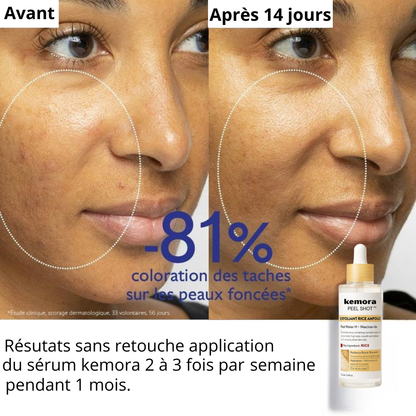 Kemora PEEL SHOT  – Sérum exfoliant élimine les points noirs & pores