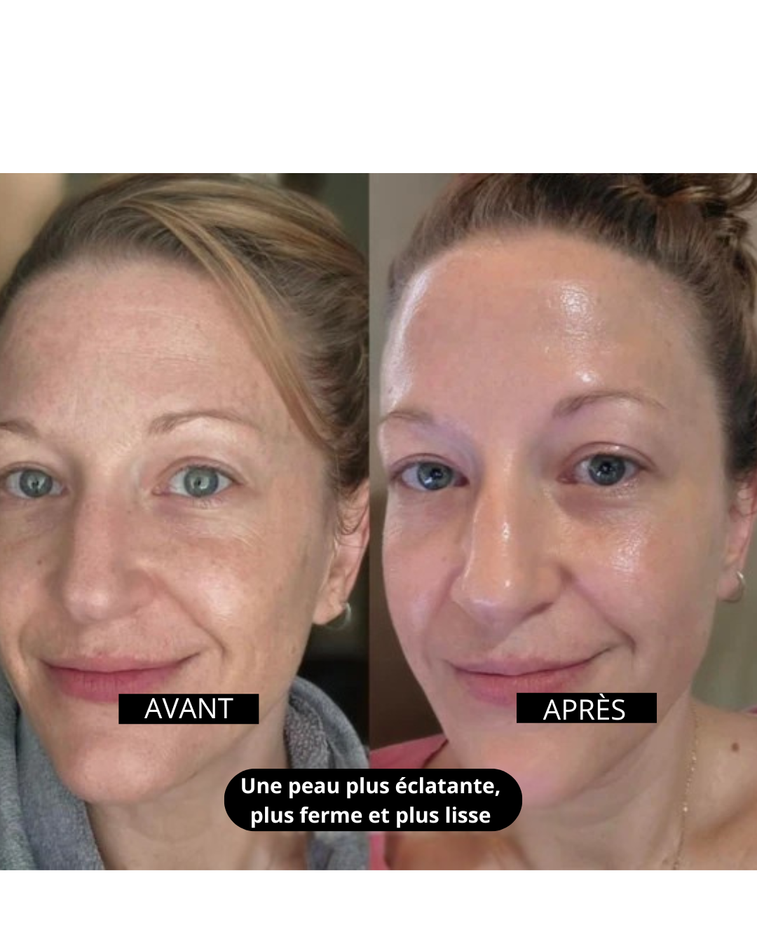 Kemora PEEL SHOT  – Sérum exfoliant élimine les points noirs & pores