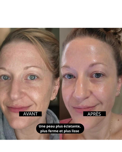 Kemora PEEL SHOT  – Sérum exfoliant élimine les points noirs & pores